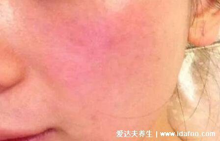 晒伤后皮肤发红怎么修复小妙招,先冰敷再涂抹芦荟胶/黄瓜片