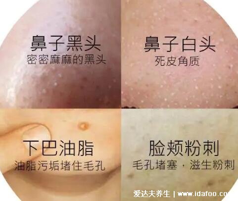 白头粉刺图片,不痛不痒白色凸起鼻子额头可有(黑头粉刺区别)