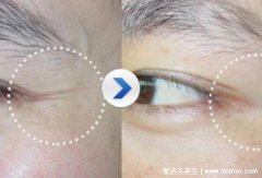 4种治疗鱼尾纹的方法，不仅仅是通过手术去