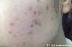 16个去除痘印的小妙招,白芷粉加蜂蜜敷脸淡