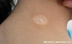 白颠疯病初期照片，全身多处白癜风早期症