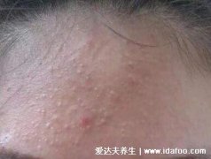 闭口是什么长什么样子图片，额头鼻翼两侧