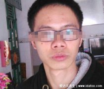 标准蒜头鼻图片,鼻子扁平鼻翼宽大肥厚(面