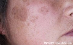 初早期面部老年斑图片高清图，老年斑的形