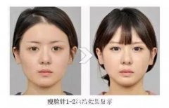 打完一针瘦脸针效果图,6个月内瘦脸效果看