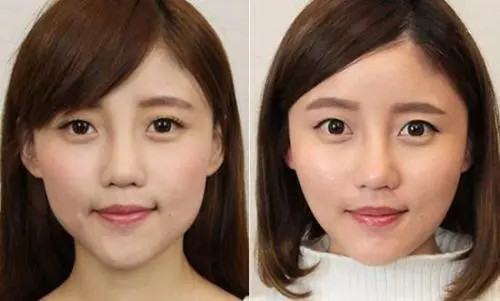 打完瘦脸针的图片效果对比,三个月脸型变