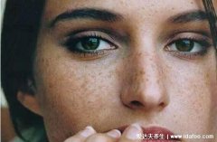 蝴蝶斑是什么样的图片，脸颊两侧的黄褐斑