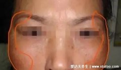 蝴蝶斑是什么样的图片，长在脸颊两侧的黄