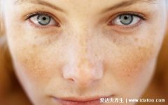黄褐斑怎样才能彻底的去掉，6种方法轻松消
