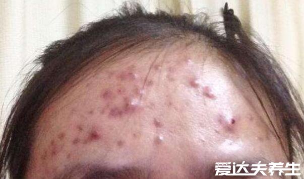 脸上长痘痘的位置图解，额头长痘对应肝脏排毒出现问题