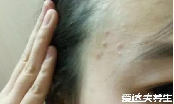 脸上长痘痘的位置图解，额头长痘对应肝脏排毒出现问题