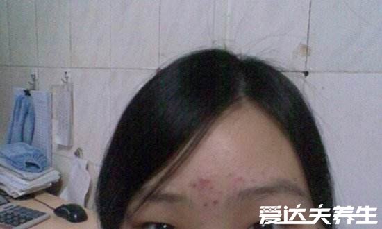 眉心长痘痘是什么原因，很可能是心脏活力减弱造成的
