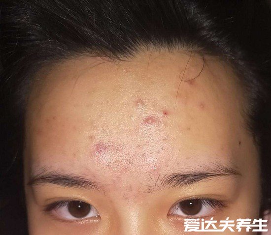 眉心长痘痘是什么原因，很可能是心脏活力减弱造成的