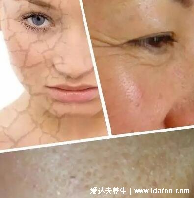 每天坚持敷面膜五年后,皮肤敏感依赖性皮炎(停用后缺水有细纹)