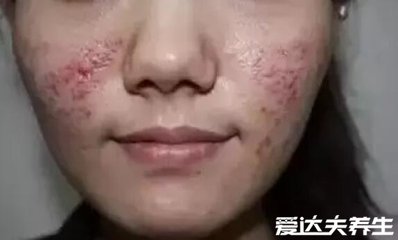 水光针的副作用和危害,可能引发皮肤感染出现红肿症状
