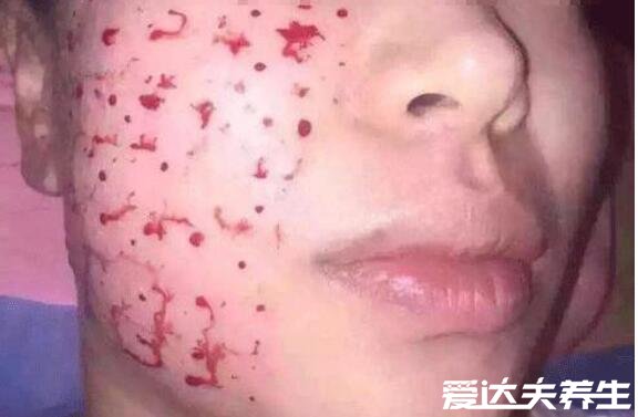 水光针的副作用和危害,可能引发皮肤感染出现红肿症状