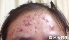 脸上长痘痘的位置图解，额头长痘对应肝脏