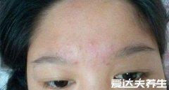 眉心长痘痘是什么原因，很可能是心脏活力