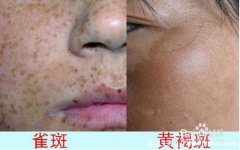 雀斑图片高清和黄褐斑区别，4张图教你辨别