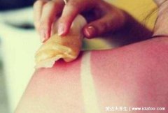 晒伤后皮肤发红疼痛怎么办,5个晒后修复的