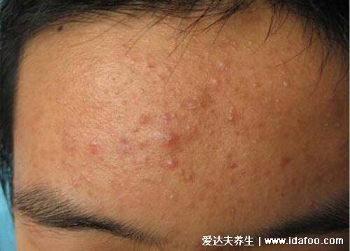 炎症丘疹型痘痘图片，不及时治疗会发展成脓包留疤