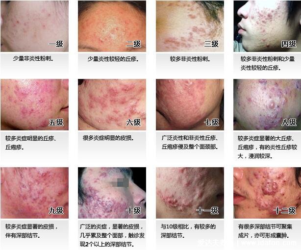 炎症丘疹型痘痘图片，不及时治疗会发展成脓包留疤