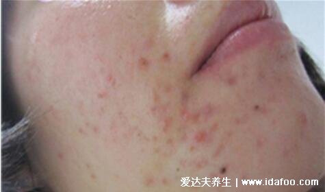 炎症丘疹型痘痘图片，不及时治疗会发展成脓包留疤