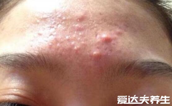 长痘痘的位置图解，不同部位长痘代表的含义皆不同