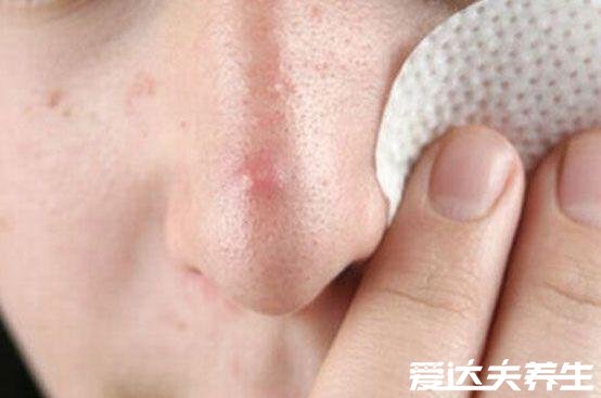 长痘痘的位置图解，不同部位长痘代表的含义皆不同