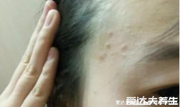 长痘痘的位置图解，长痘暗示身体出现了问题(唇周与便秘有关) 