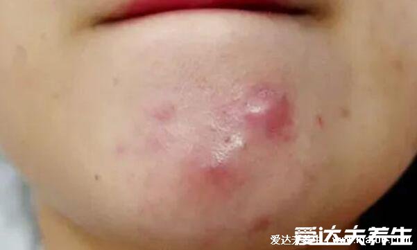 长痘痘的位置图解，长痘暗示身体出现了问题(唇周与便秘有关) 