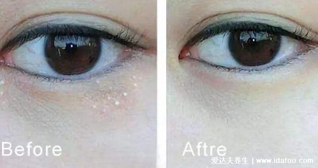 脂肪粒怎么去除小窍门,用针挑出脂肪粒最快最有效