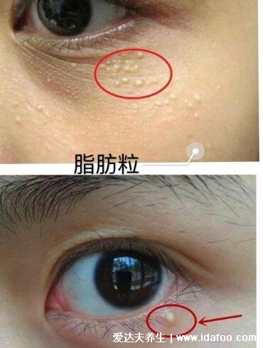 脂肪粒怎么消除在眼睛旁边的,5个脂肪粒怎么去除小窍门(涂抹维生素e)
