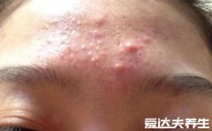长痘痘的位置图解，不同部位长痘代表的