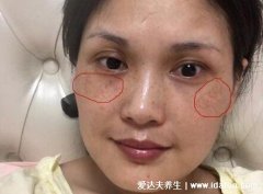 真实的黄褐斑蝴蝶斑图片，两颊变成棕黑