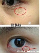 脂肪粒怎么消除在眼睛旁边的,5个脂肪粒怎