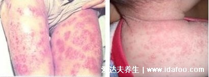 过敏性皮炎图片和症状,会瘙痒有疹子(化妆品或者日晒可引起)