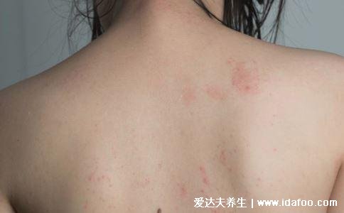 过敏性皮炎图片和症状,会瘙痒有疹子(化妆品或者日晒可引起)