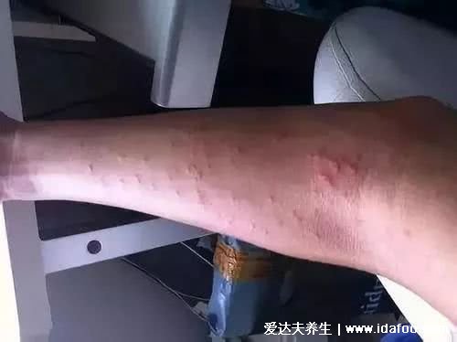 过敏性皮炎图片和症状,会瘙痒有疹子(化妆品或者日晒可引起)