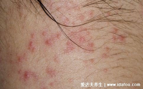 过敏性皮炎图片和症状,会瘙痒有疹子(化妆品或者日晒可引起)