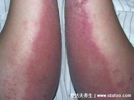 过敏性皮炎图片和症状,会瘙痒有疹子(化妆品或者日晒可引起)