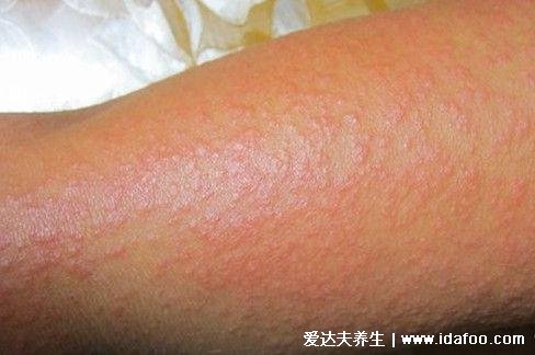 过敏性皮炎图片和症状,会瘙痒有疹子(化妆品或者日晒可引起)