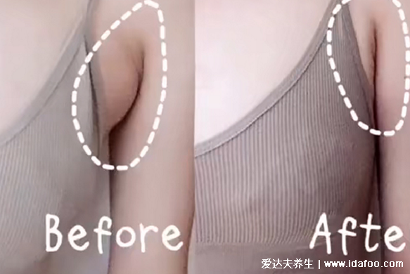 女人长副乳图片,教你怎么判断是副乳还是赘肉