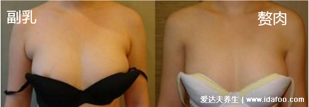 女人长副乳图片,教你怎么判断是副乳还是赘肉