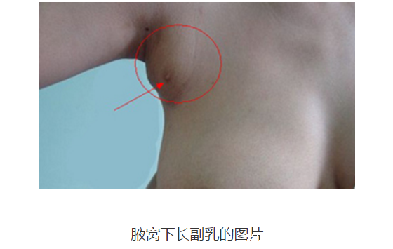 女人长副乳图片,教你怎么判断是副乳还是赘肉