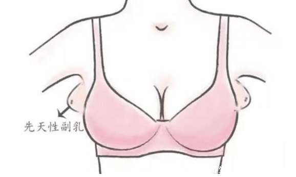 女人长副乳图片,教你怎么判断是副乳还是赘肉