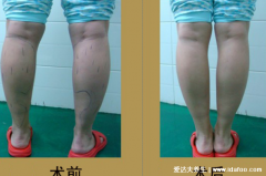 手术吸脂40斤要多少钱，抽脂减肥价格一览表