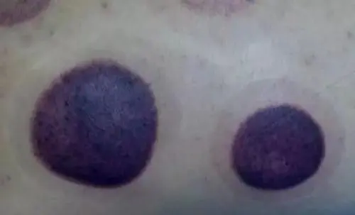 背部拔罐后湿气重图片讲解,紫黑色代表有