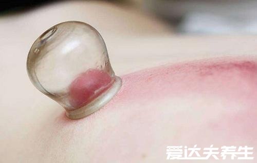 拔火罐有什么好处,拔火罐的好处和坏处