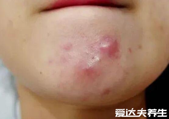 脸部长痘对应五脏的图,可不是内分泌失调那么简单